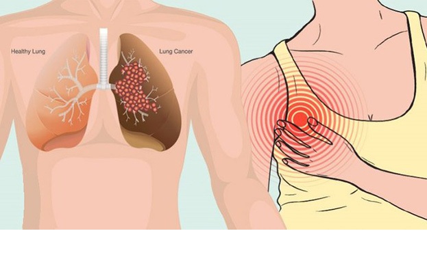 Tràn dịch phổi và ung thư phổi